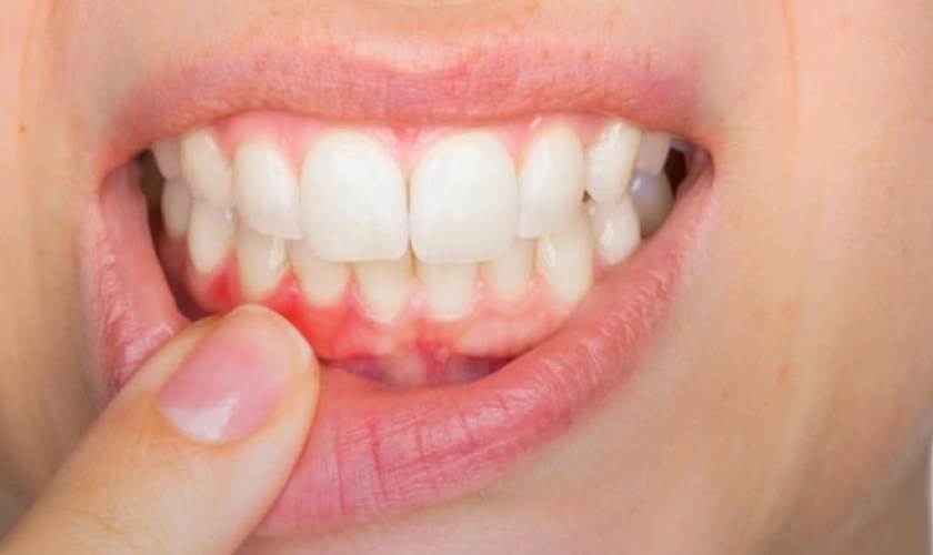 Gum Disease Detection