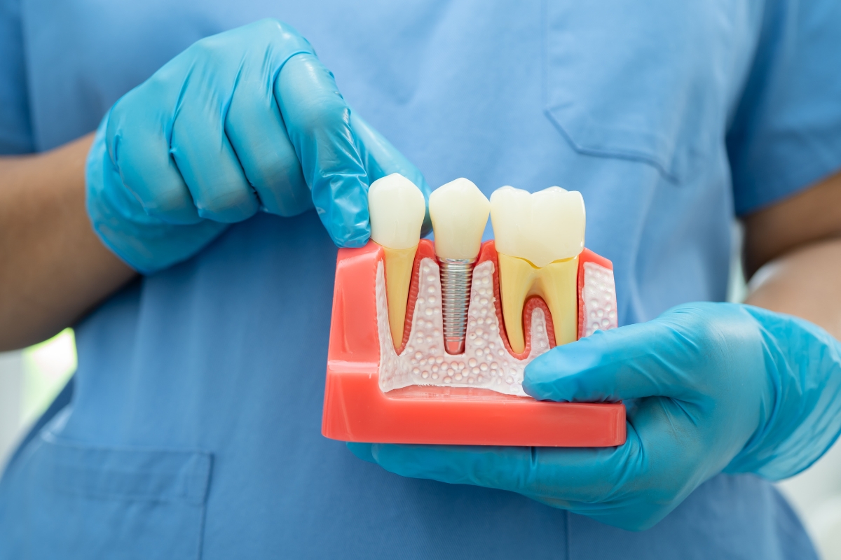 dental implants in Northville